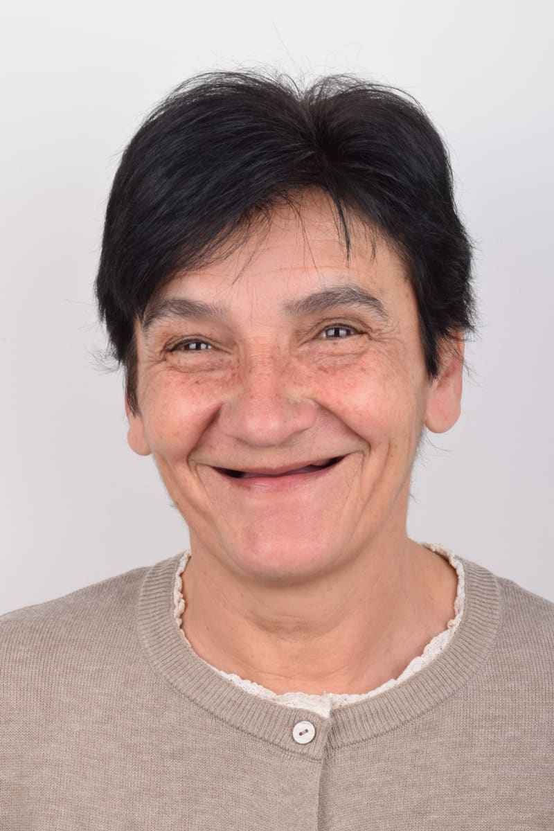 Pacijentkinja Zorica · prije ugradnje implanata